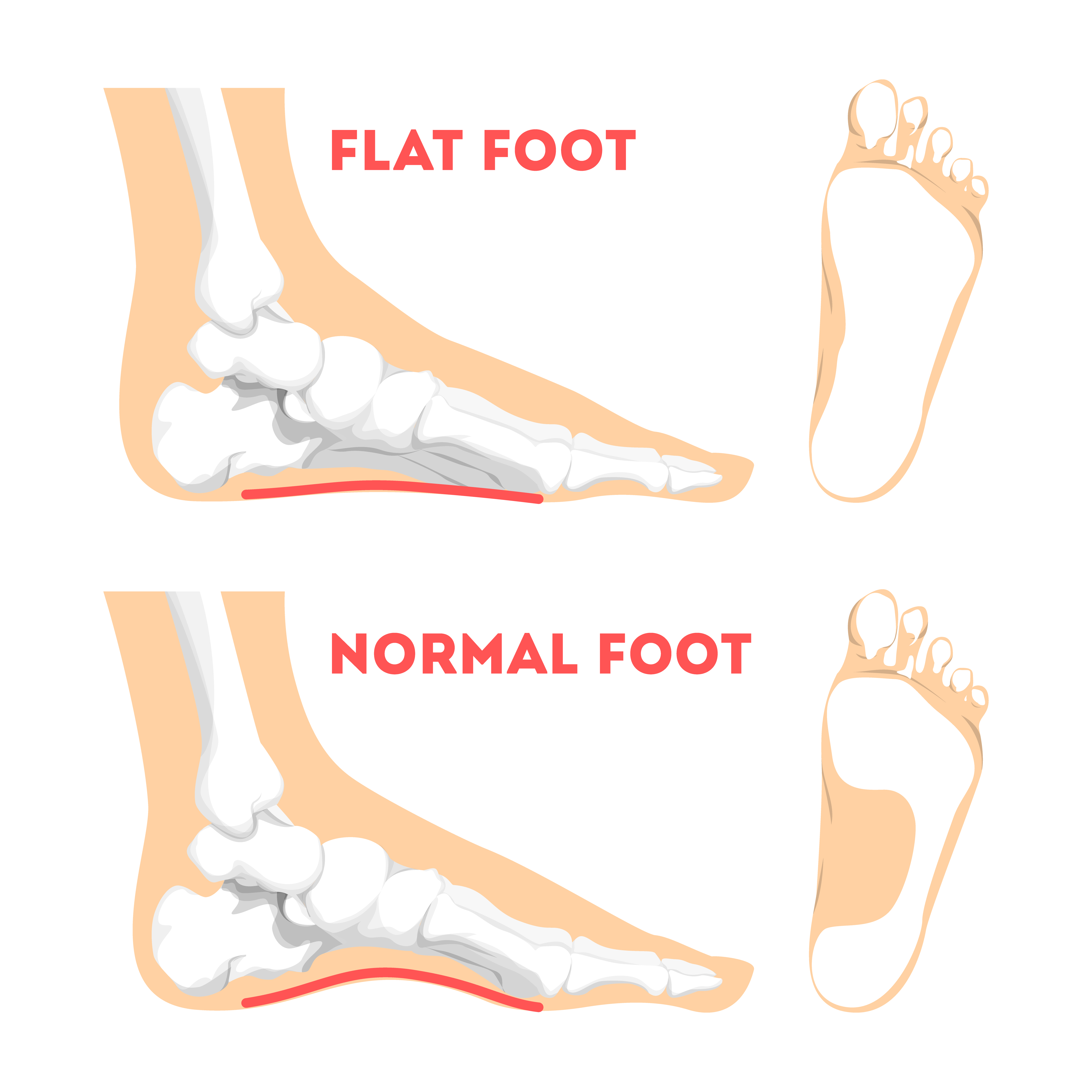 Flat Foot ? Causes Symptoms & Treatment